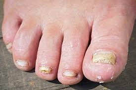 Homeopathy Medicine for Nail Fungus